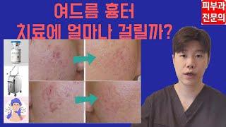 여드름 흉터 치료, 맞는 방법은 따로 있다? 피부과전문의가 알려드립니다 !