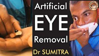 How to : Artificial eye removal | Dr Sumitra |  नकली आँख