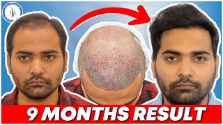 Best Hair Transplant in Surat | Best Hair Transplant Result & Cost in Surat Gujarat