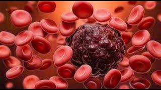 Leukemia: Blood Cancer Types, Symptoms & Treatment