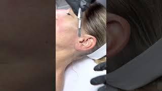 Dermaplaning