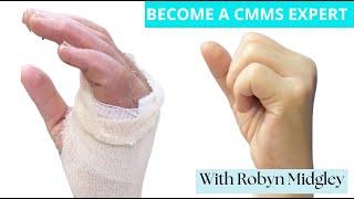 Success with CMMS using Robyn Midgley's MCPJ Immobilisation cast