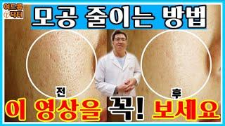 모공 줄이는 방법! 이 영상을 꼭!! 보세요. 아크네마인드 원장 여드름 닥터가 알려드립니다.