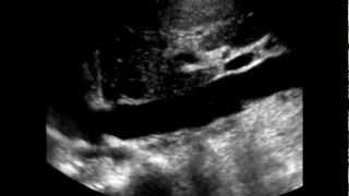 Mobile Thrombus in the IVC