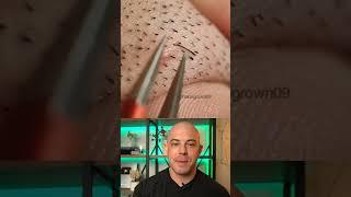 Derm reacts to stubborn ingrown hair removal! #dermreacts #doctorreacts #ingrownhair