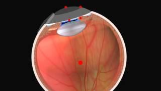 Rotation Balance - SCHWIND AMARIS eye tracking