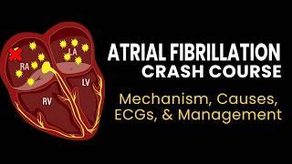 AFib Crash Course: Mechanism, ECG, Causes, & Management