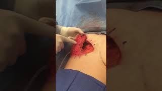 FTM  Double Incision Nipple Sensation Preserving Surgery