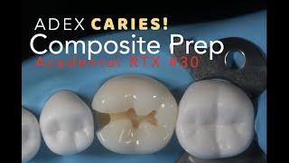 Class II Composite Preparation for ADEX Caries #30 MO