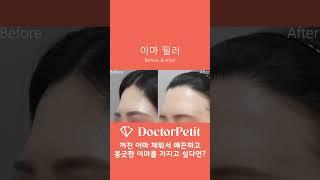[닥터쁘띠] 닥터쁘띠의원 일산점 이마필러 전후 사진 비교! 매끈하고 봉긋한 이마 가지고 싶다면? #피부과  #필러 #이마필러 #이마주름 #보톡스 #shorts #피부관리 #주름