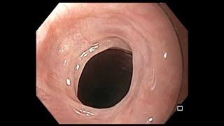 Esophagus - Postcricoid esophageal web associated difficulty swallowing pills