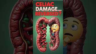 Celiac Disease: Can You Fully Recover? Find Out Now! #shorts #celiac #celiacdisease
