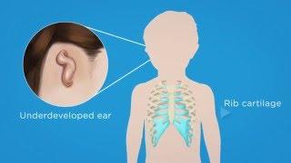 Microtia Surgery For Ear Reconstruction