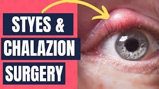 Surgery for Styes and Chalazions and Eyelid Bumps!