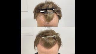 FUE Hair Transplant Result (1700 Grafts ) - The Treatment Rooms London, Hair Transplant Clinic