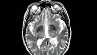 Cerebrovascular Disease Acute stroke writes but cannot read