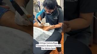 Vitiligo Treatment @pune