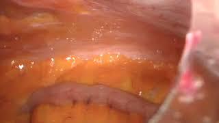 Perforazione iatrogena colon discendente-sigma. Wash and drain videolaparoscopico