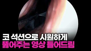 코 석션으로 시원하게 뚫어봤습니다 코 석션으로 뚫기