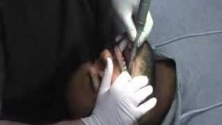 Removing Braces