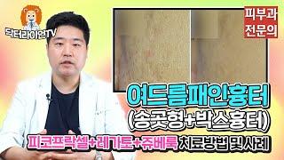 여드름패인흉터(송곳형,박스모양흉터) 피코프락셀레이저+레가또+콜라겐부스터 치료 사례