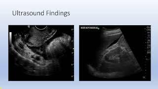 Ectopic Pregnancy