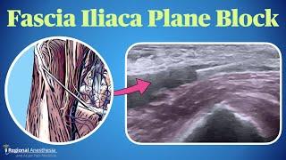 Fascia Iliaca Plane Block