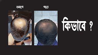 চুলের সমস্যার একমাত্র সমাধান ! FDA এপ্রুভ !