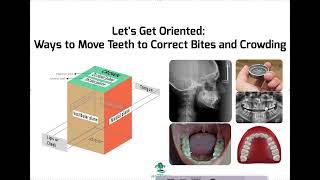 Ways to Move Teeth and Correct Crowding: IPR, SD, Expansion, Proclination, Extraction