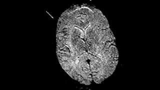 Altered brain perfusion