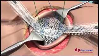 UCMC ClearMesh Composite - Umbilical Hernia Repair