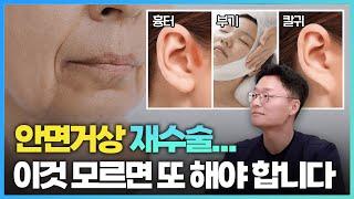 안면거상 재수술에 대한 모든 것 (feat. 안면거상술 실패 원인)