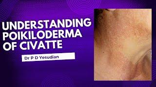 Understanding Poikiloderma of Civatte - causes, clinical features and treatment of neck pigmentation