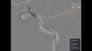 Mentice Neurovascular Brain Aneurysm Coiling Demo