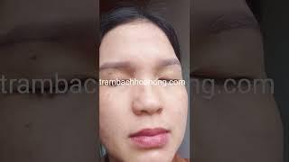Bạch hoa hồng có được gọi là trùm trị mụn ko há ?