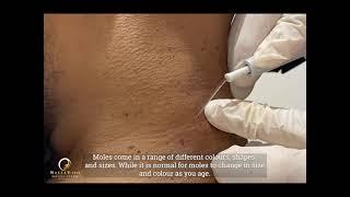 Mole removal in Dubai