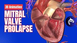 Mitral Valve Prolapse - 3D Animation