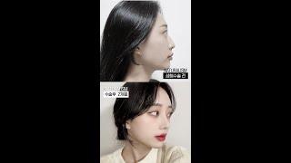 자연주의성형외과 쌍수+코성형+얼굴지방이식 성형전후영상
