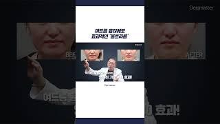 여드름 흉터에도 효과적인 울트라콜 #shorts