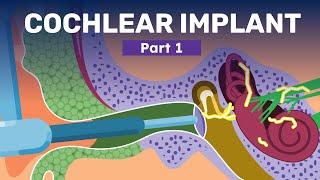 What is A Cochlear Implant? | How Hearing Aids and Implants Help Recover Hearing Loss