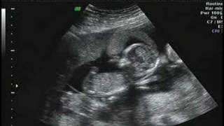 wilkinsonquints ultrasound 2