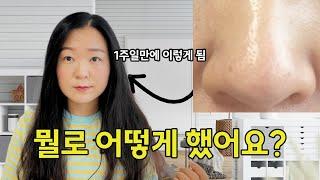 블랙헤드 제거 절대 이건 하지 마세요. 블랙헤드 안생기게 하는 법. 클렌징 오일 꼭 이렇게 쓰세요. (추천제품 정리)