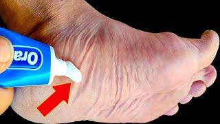 Stop spending money at the pharmacy! Just put TOOTHPASTE on your FEET (Did you know that?)