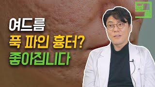 여드름 흉터, 유형별 완전 공략해드립니다