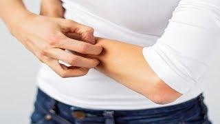 4 bệnh ngoài da dễ mắc vào mùa đông