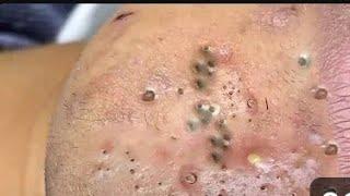 Relaxing Popping Video Pimple popping black head remove Satisfaction With Popping