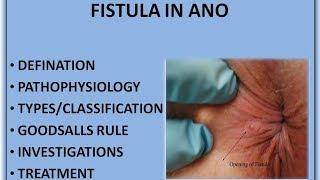 FISTULA IN ANO [HINDI]