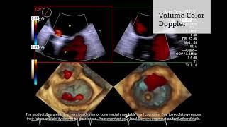 Tecnología líder en cardiología con el sistema de ultrasonido ACUSON SC2000