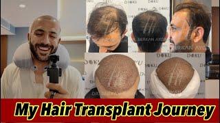 My Hair Transplant Journey | Tahir Khan Vlogs | Dr Serkin Aygün | Best Hair Transplant in Turkey |