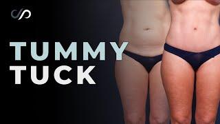 Hourglass Tummy Tuck Surgery Result